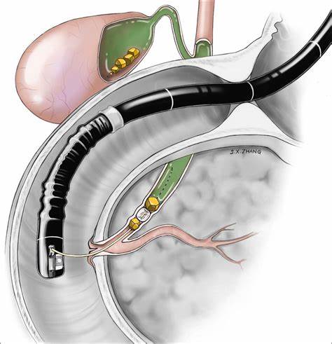 ERCP: What It Is, Why It's Done, Procedure & Complications